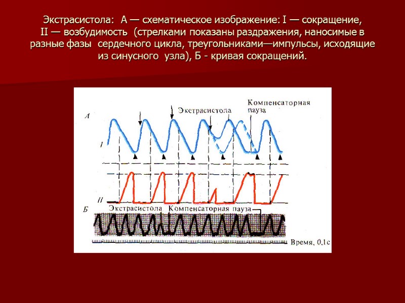 Экстрасистола:  А — схематическое изображение: I — сокращение,  II — возбудимость 